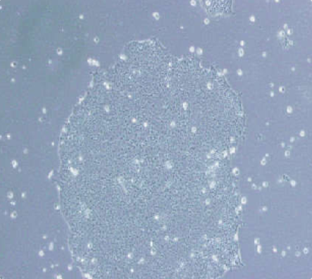 DB人弥漫性大B细胞淋巴瘤细胞