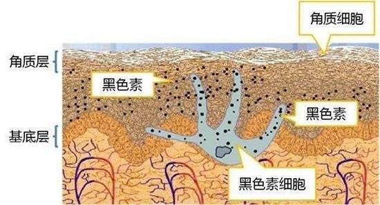 黑色素沉淀怎么办？5招淡化黑色素