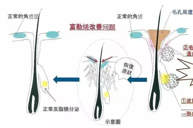 富勒烯改善胶原蛋白