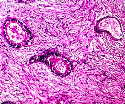 人子宫内膜腺癌(转移)细胞