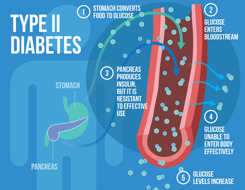 type ii diabetes