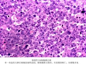 OCI-LY10(OCI-LY-10) 弥漫大B细胞淋巴瘤细胞