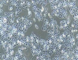 人子宫内膜腺癌(转移)细胞；AN3 CA