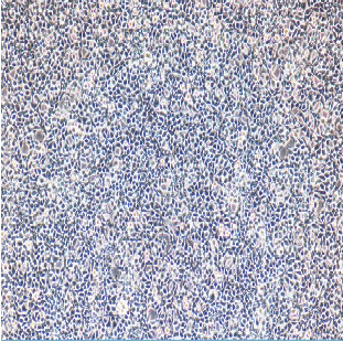 MUZT-1人骨髓增生异常综合征(MDS)细胞
