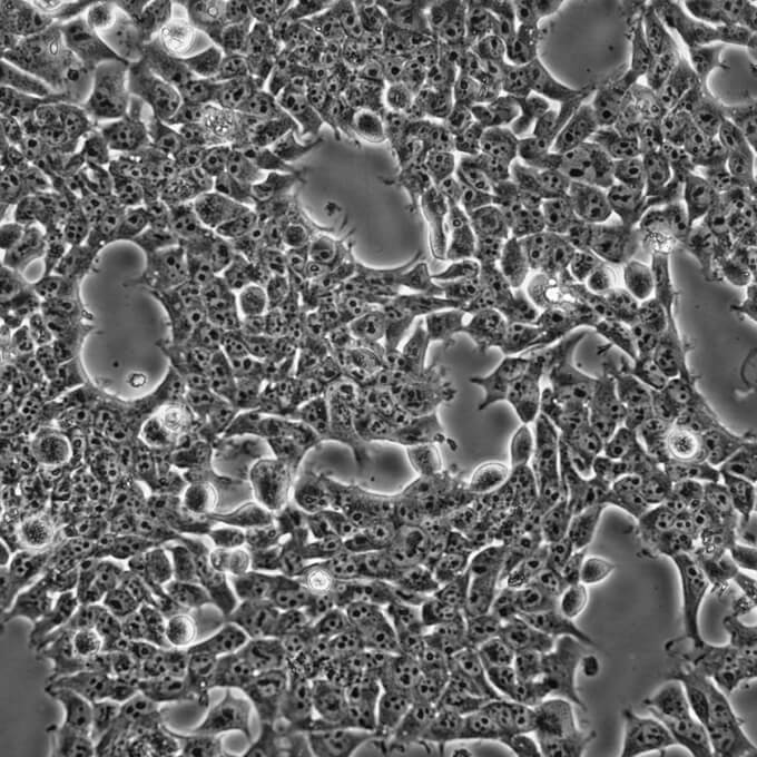 PH急性单核细胞白血病细胞