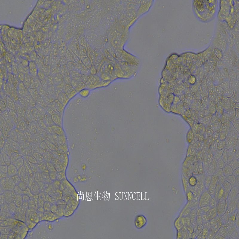 人肺腺癌(胸水细胞)