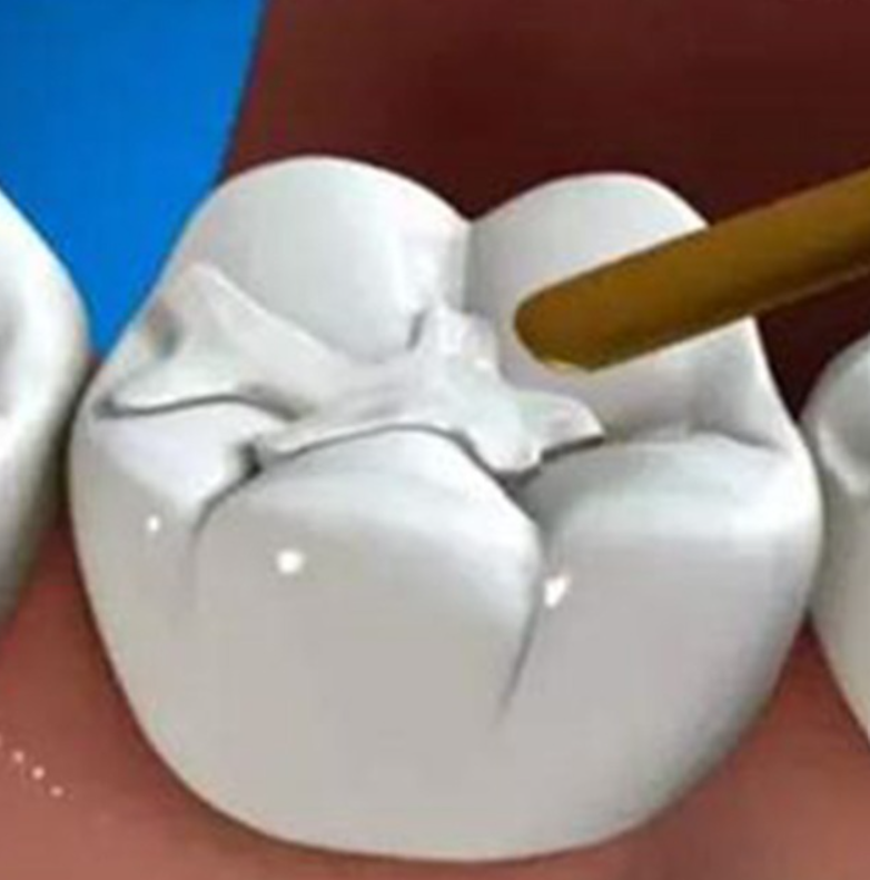 齿科填充修复树脂