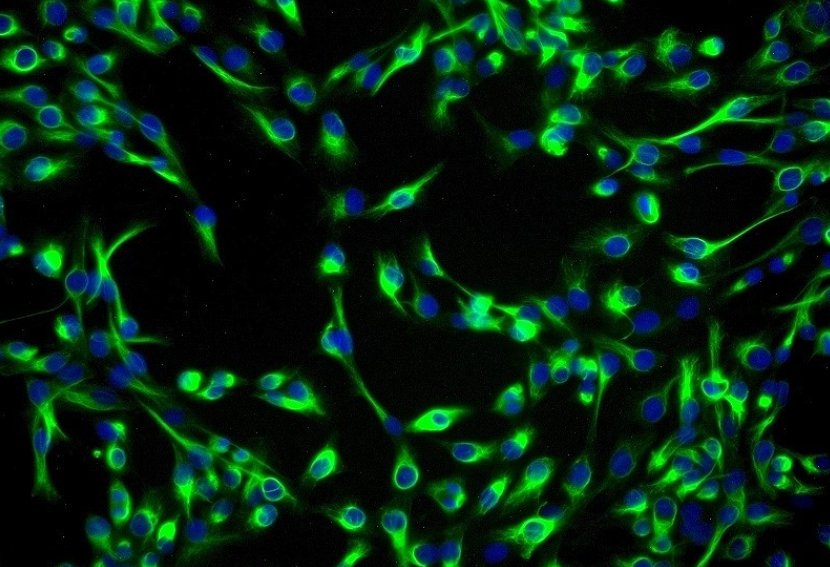 成人急性巨核细胞白血病SET2