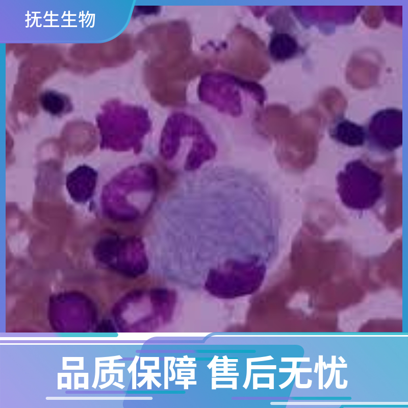 人B细胞淋巴瘤；RI-1